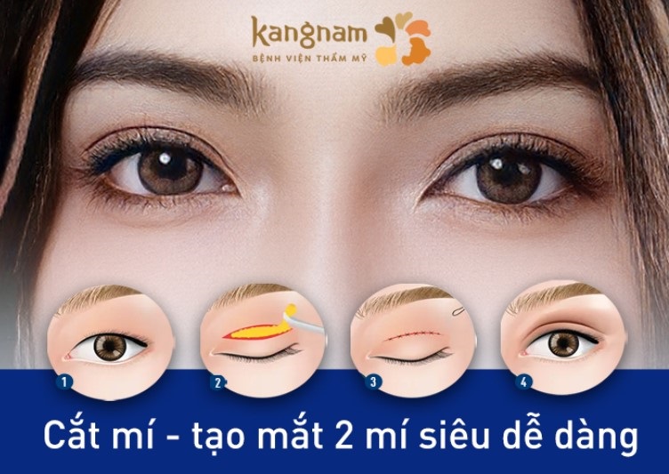 Phương pháp cắt mí tạo hình mắt 2 mí dễ dàng