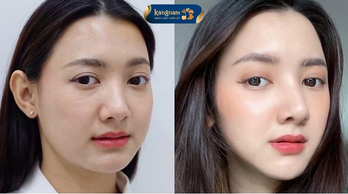 Hàm thon gọn sau thu gọn hàm vline