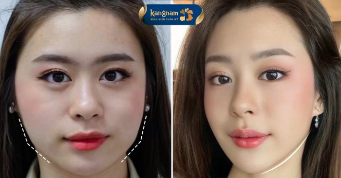 Góc mặt Vline thanh tú cuốn hút hơn sau phẫu thuật