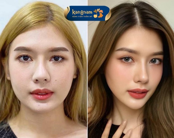 Phương pháp thu gọn góc hàm phù hợp với hầu hết đối tượng