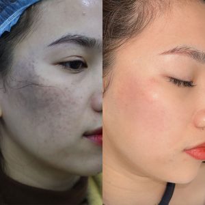 Xóa chàm bớt bẩm sinh hiệu quả, nhanh chóng, không đau