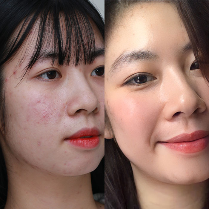 Trị mụn chuẩn Y khoa – Cam kết hiệu quả, an toàn