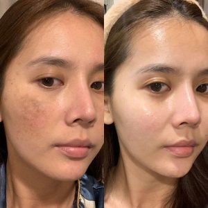 Điều trị nám, tàn nhang hiệu quả với công nghệ Laser Top 1 thế giới