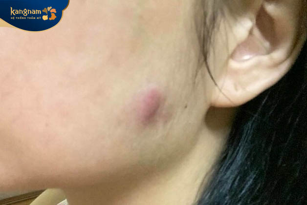 Có thể xuất hiện tình trạng sưng bầm trên da sau tiêm botox