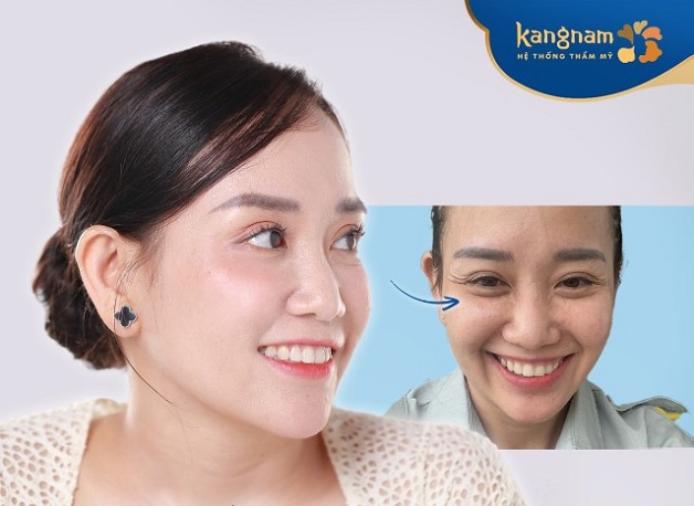 Phương pháp tiêm botox xóa nhăn