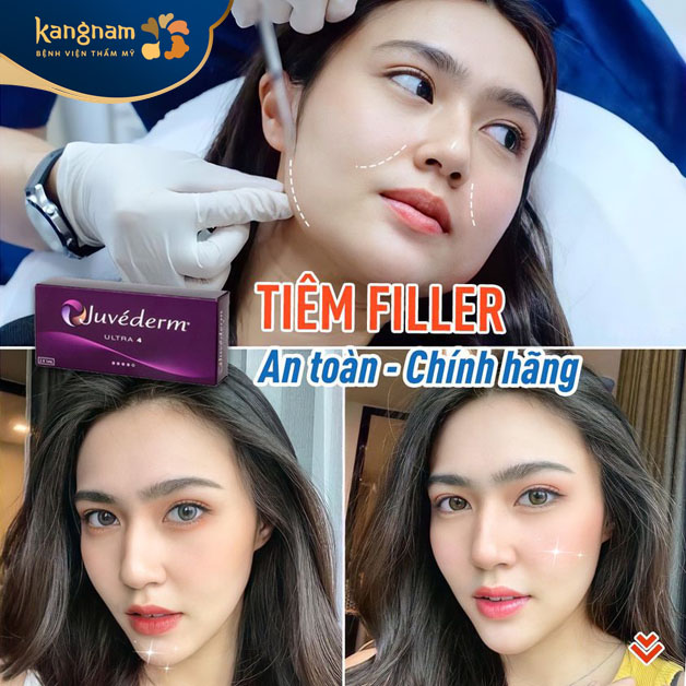 Kangnam sử dụng filler an toàn, chính hãng