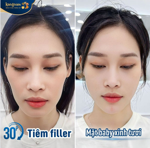 Khách hàng trẻ ra đến 10 tuổi sau khi lấp đầy thái dương lõm và má hóp