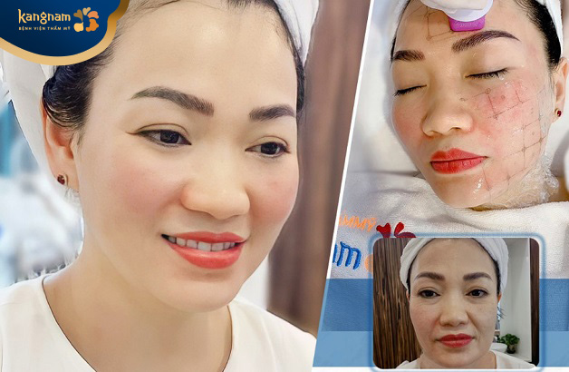 Làn da cải thiện rõ rệt sau Thermage FLX