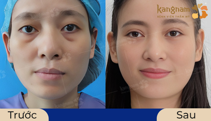 Cấy mỡ kết hợp cắt mí làm trẻ hóa đôi mắt