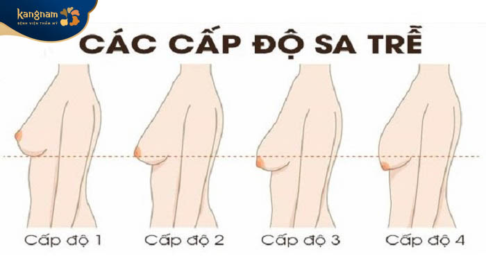 Các cấp độ treo sa trễ