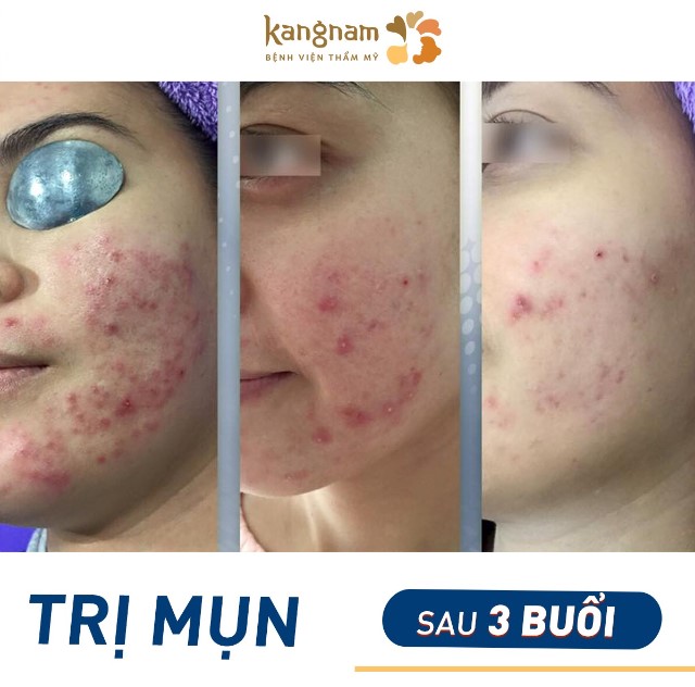 Cải thiện mụn viêm sau 3 buổi điều trị