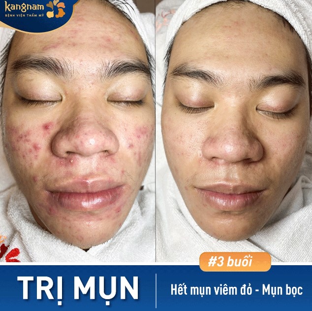 Trị mụn tại Kangnam hết mụn viêm đỏ, mụn bọc