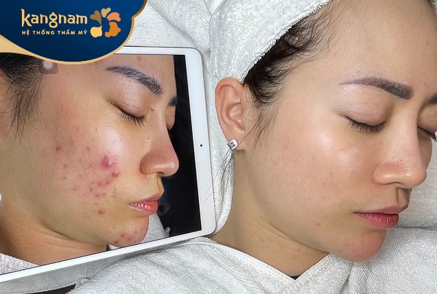 Bạn Thu Ngọc đã cảm thấy tự tin hơn sau trị mụn