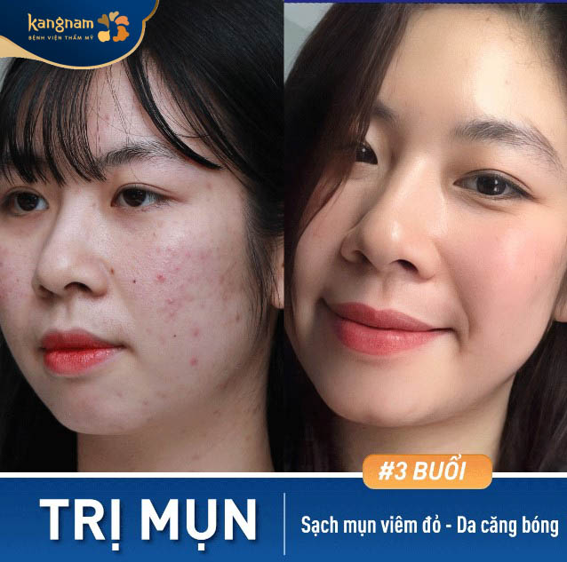 Bạn Hồng Linh cảm thấy hài lòng sau khi trị mụn tại Kangnam