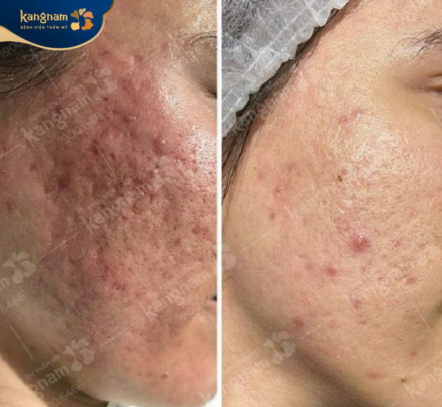 Trị sẹo tai Kangnam mang lại kết quả tối ưu