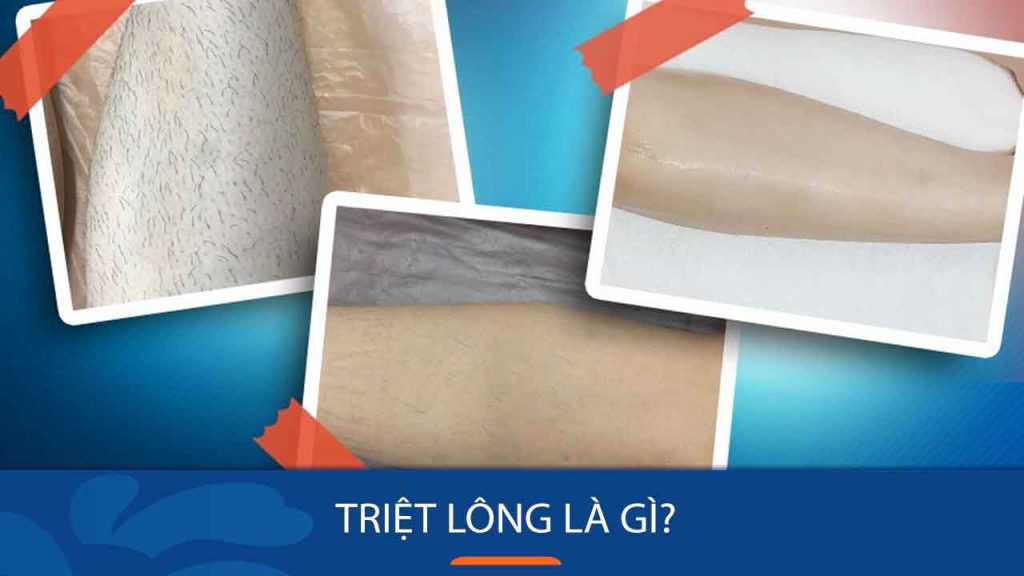 Bật Mí Phương Pháp Triệt Lông Chân Hiệu Quả, An Toàn, Không Đau Rát