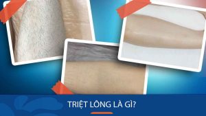 Bật Mí Phương Pháp Triệt Lông Chân Hiệu Quả, An Toàn, Không Đau Rát