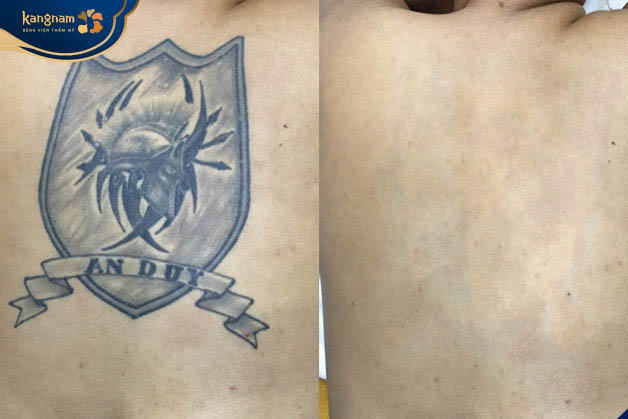 Công nghệ xóa xăm Laser Picosure xóa sạch hình xăm lâu năm cho khách nam