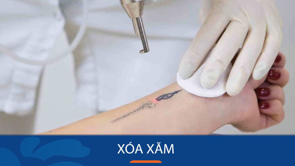 Xóa xăm là gì? Công nghệ xóa xăm hiện đại không để lại sẹo