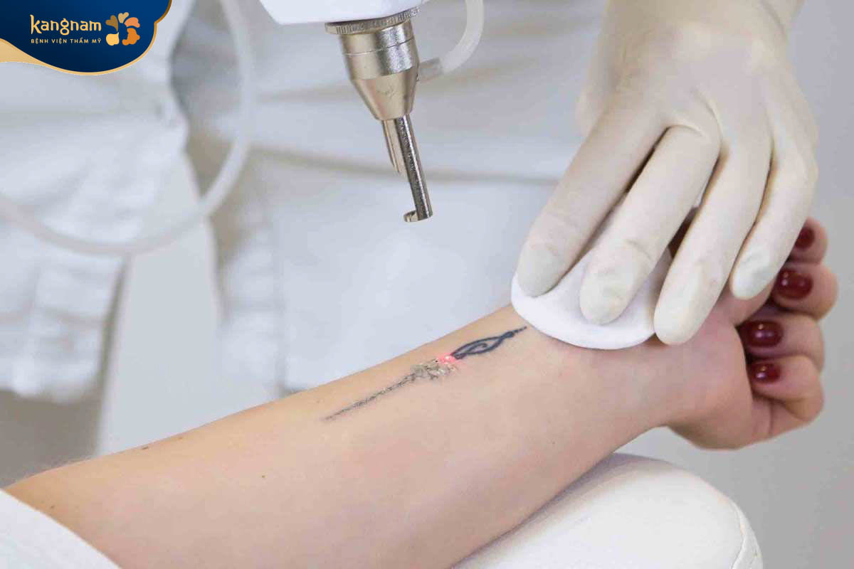 Xóa xăm là bỏ hình xăm cũ bằng việc loại bỏ hạt mực xăm nằm dưới da