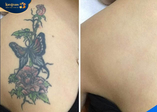 Hình xăm màu lâu năm ở vai được giải quyết hoàn toàn