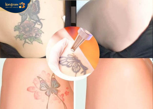 Xóa xăm an toàn, không tổn thương da