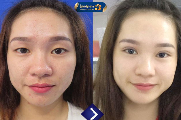 Phương pháp bấm mí Hàn Quốc tại Kangnam thường có thời gian hồi phục ngắn