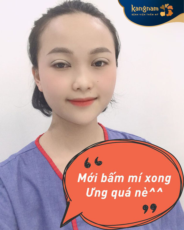 Kangnam là địa chỉ bấm mí ít sưng, nhanh hồi phục