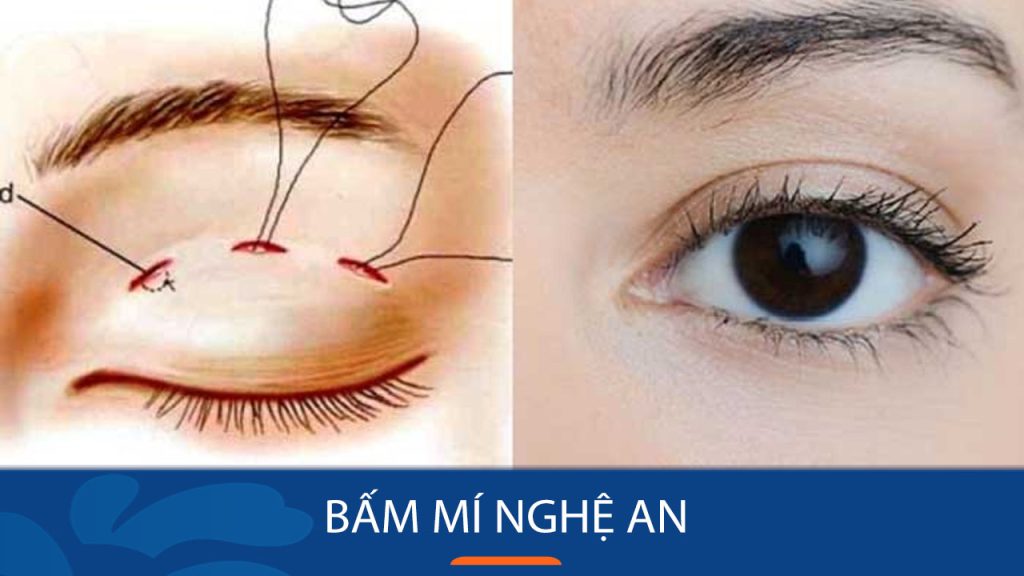 Bấm mí kangnam Nghệ An – Tạo nếp mí tự nhiên cho đôi mắt to tròn