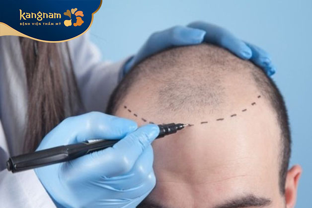 Các yếu tố ảnh hưởng đến kết quả cấy tóc