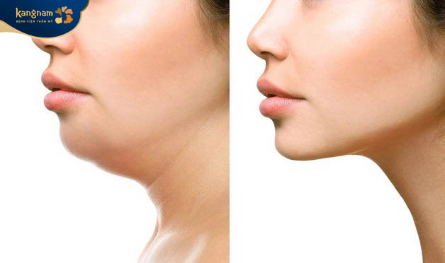 So với khuôn mặt tỉ lệ vàng (phải) thì cằm lẹm (trái) gây mất cân đối do hụt vào trong