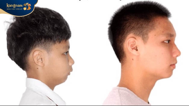 Yếu tố di truyền, sai khớp cắn, mắc bệnh ung thư là nguyên nhân gây lẹm cằm