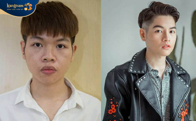 Ca sĩ Đức Phúc có sự thay đổi ngoạn mục về ngoại hình trước - sau phẫu thuật độn cằm