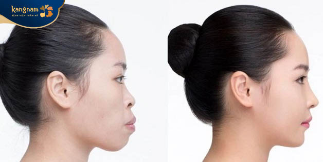 Nữ giới cằm lẹm là đặc điểm không tốt trong tướng số