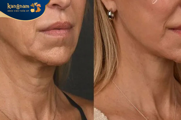 Xóa nhăn da mặt và da cổ chỉ sau 1 lần thực hiện