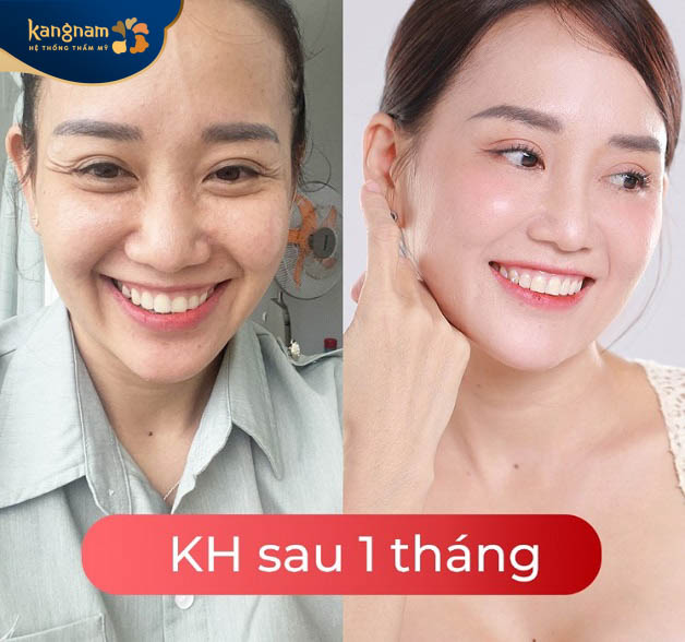 Làn da căng bóng, mịn màng sau 2 thắng căng da