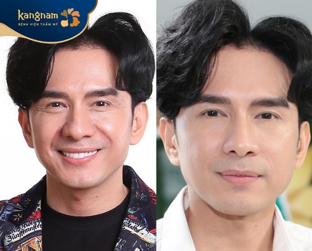 Ca sĩ Đan Trường tin tưởng lựa chọn dịch vụ căng da tại Kangnam