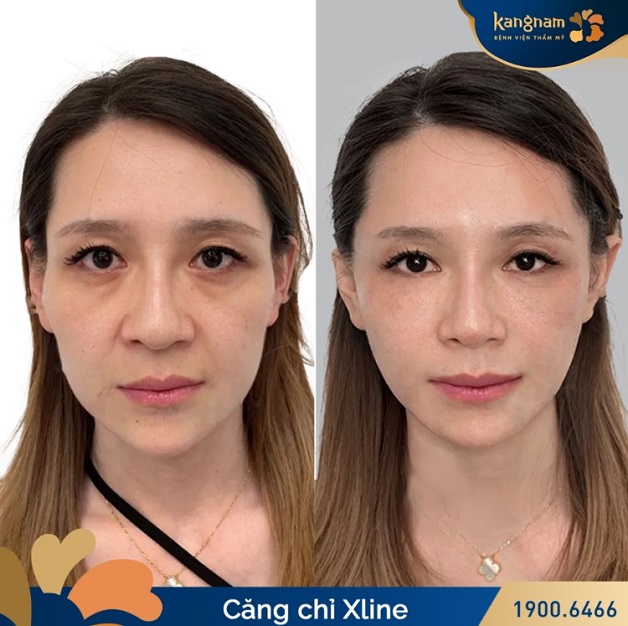 Căng da bằng chỉ Xline là dịch vụ nổi bật tại Kangnam được nhiều khách hàng lựa chọn