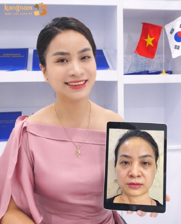 Khách hàng rạng rỡ, hài lòng với kết quả sau căng da mặt