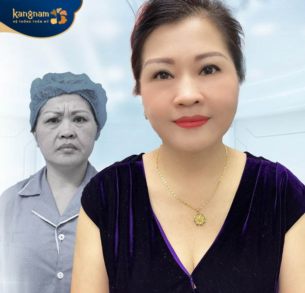 Căng da mặt Hải Phòng được khách hàng quan tâm