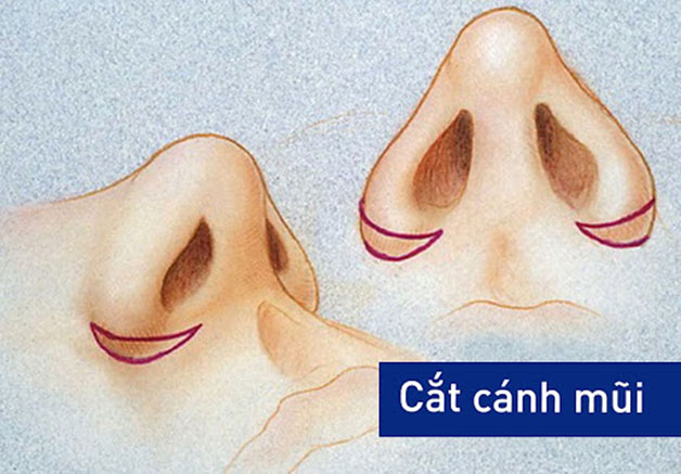 Thu gọn cánh mũi nội soi là một tiểu phẫu đơn giản nhằm thu nhỏ bớt cánh mũi