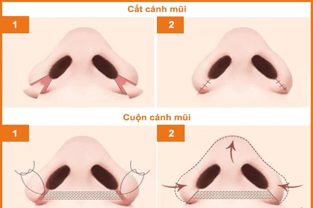 Kỹ thuật cắt/cuộn cánh mũi cũng ảnh hưởng đến vết sẹo