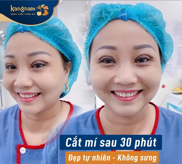 Cắt mí Plasma hạn chế sưng đau, đẹp tự nhiên