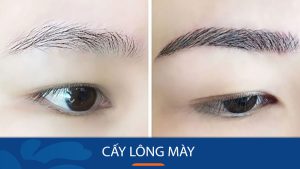 Phương pháp cấy lông mày là gì?Ưu điểm nổi bật