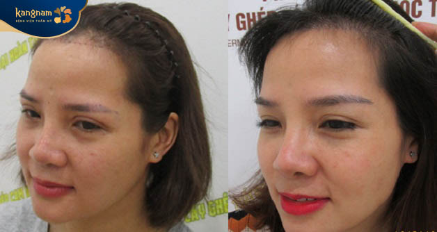 Chị Diên chia sẻ về trải nghiệm sau khi cấy lông chân mày