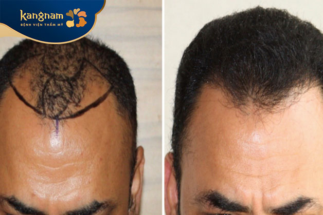 cấy nang tóc tự thân mang lại hiệu quả cao