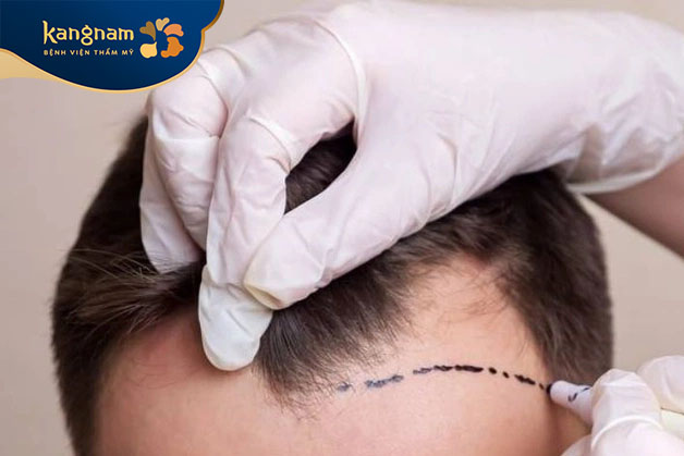 HAT là kỹ thuật tiên tiến