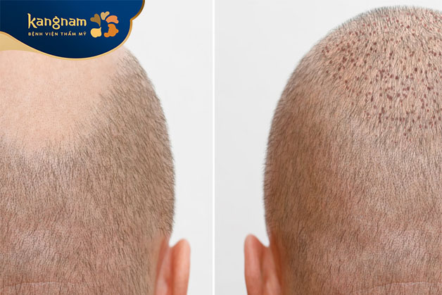 Quá trình cấy tóc không gây đau đớn