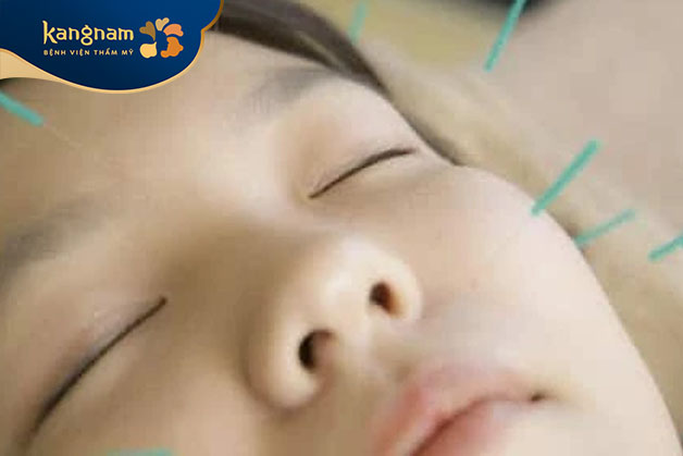 Châm cứu cải thiện mặt lệch