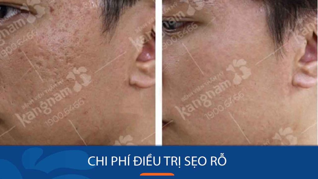 Chi phí điều trị sẹo rỗ tại Kangnam bao nhiêu? Bảng giá chi tiết